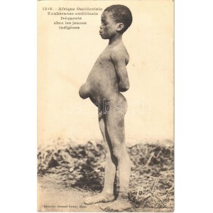 Afrique Occidentale, Exubérance ombilicale fréquente ches les jeunes indigenes / African folklore